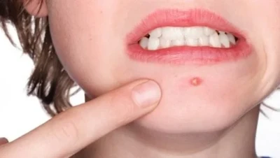 تفسير حلم الحبوب في الوجه