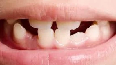 تفسير حلم سقوط سن واحد سفلي في اليد: دلالات الخير والتحذير