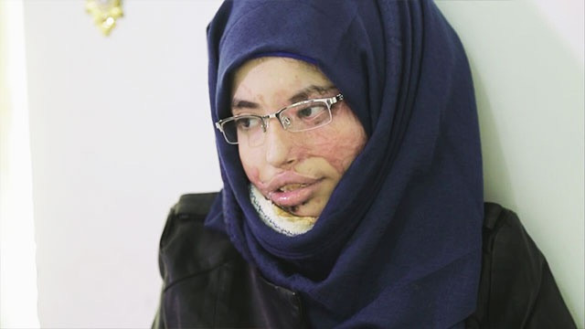 "العنود شريان" ضحية زواج الأطفال في اليمن تروي قصتها