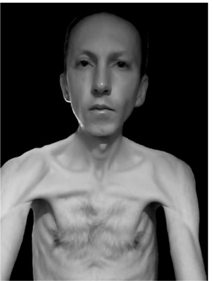 "قد يموت قريبا" خبراء الأمم المتحدة يطالبون بالإفراج عن إيراني ـ سويدي