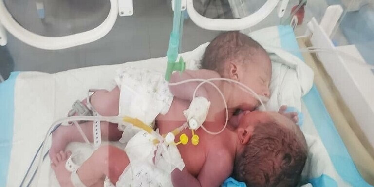 "من أجل توأم سيامي".. ميليشيا الحوثيين تناشد الأمم المتحدة